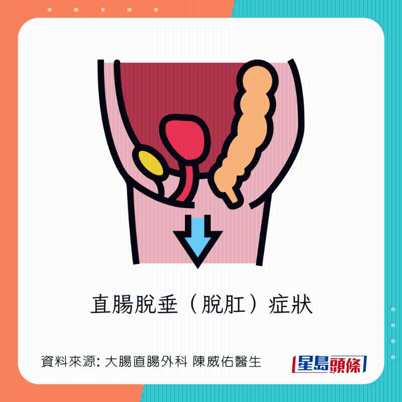 直腸脫垂(脫肛)癥狀