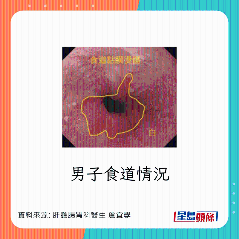 男患者食道灼傷，可惡化成食道癌
