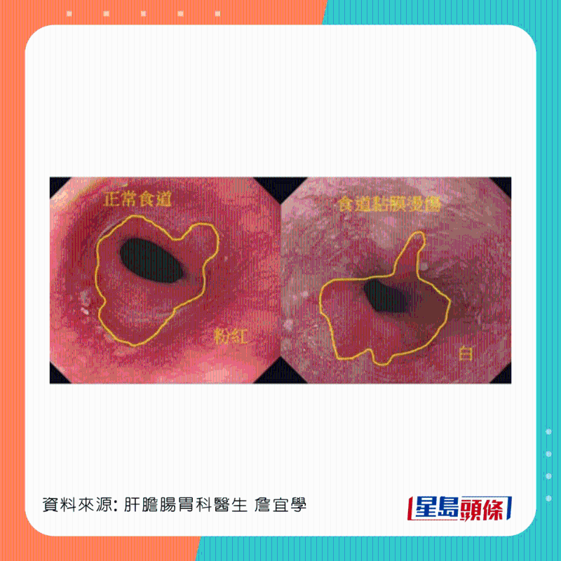 男患者食道灼傷，可惡化成食道癌