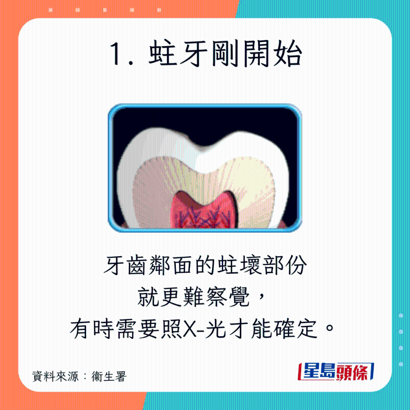 蛀牙癥狀及治療方法