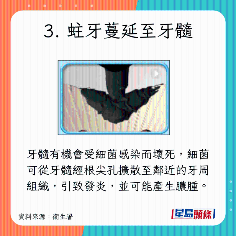 蛀牙癥狀及治療方法