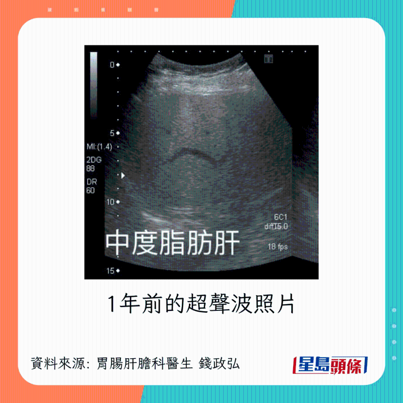 liver_4_0