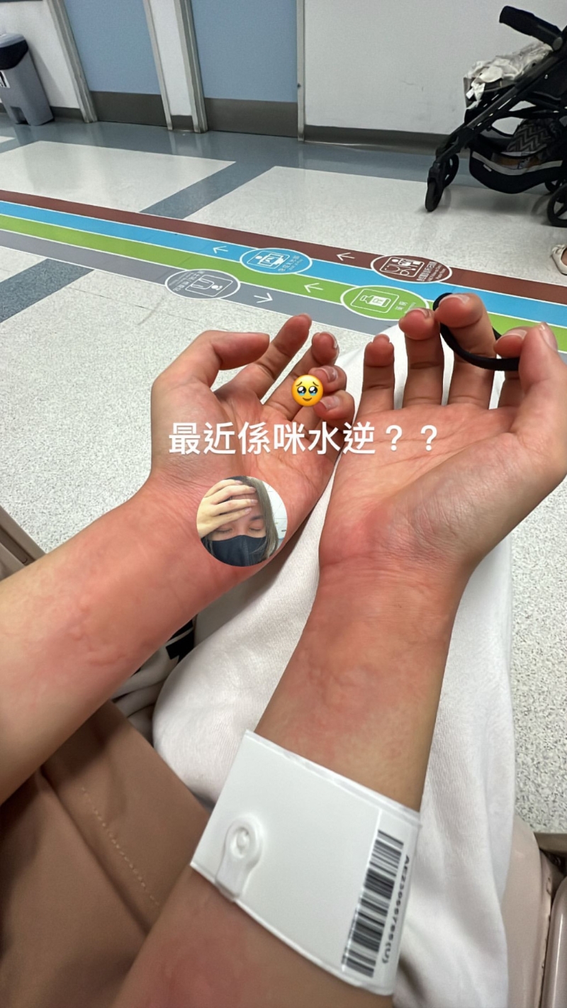 莊子璇昨日凌晨曬出照片，見她手上戴上病人手帶，兩雙手腕及前臂位置又紅又腫。