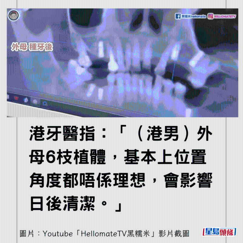 港牙醫(yī)指深圳牙醫(yī)犯三大錯(cuò)4
