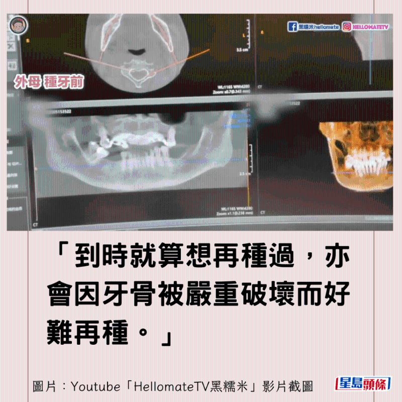 港牙醫(yī)指深圳牙醫(yī)犯三大錯(cuò)1
