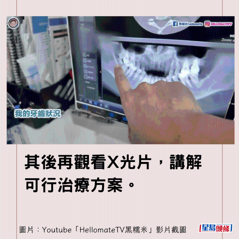 香港男子實(shí)測(cè)深圳平價(jià)洗牙種牙20