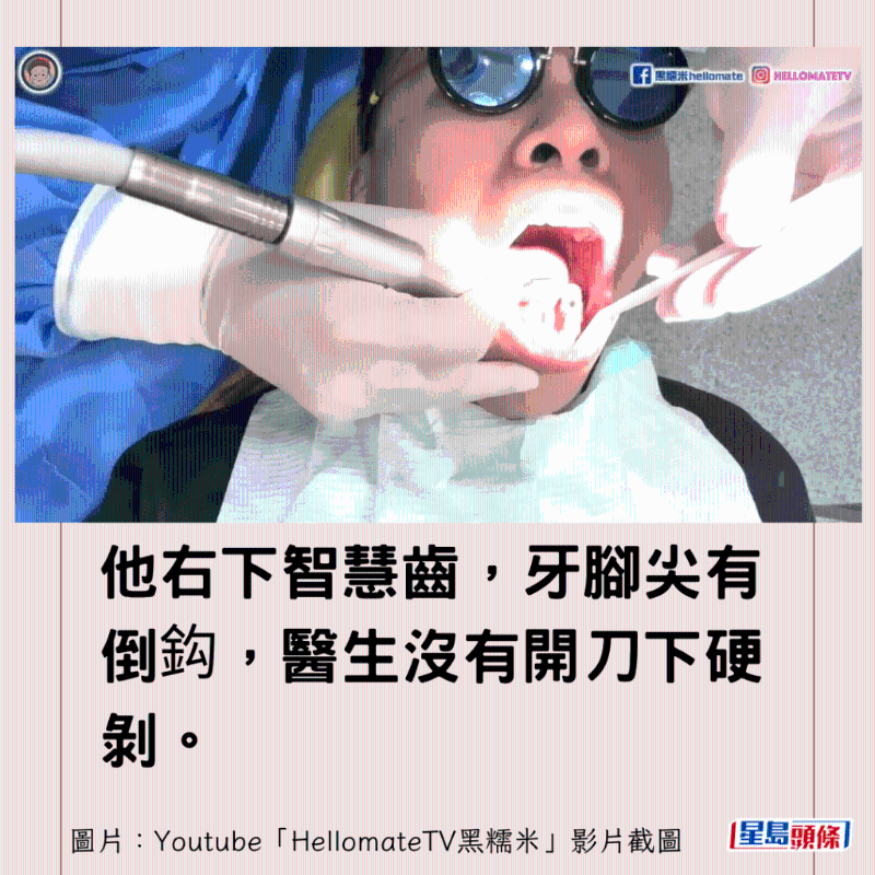 香港男子實(shí)測(cè)深圳平價(jià)洗牙種牙15