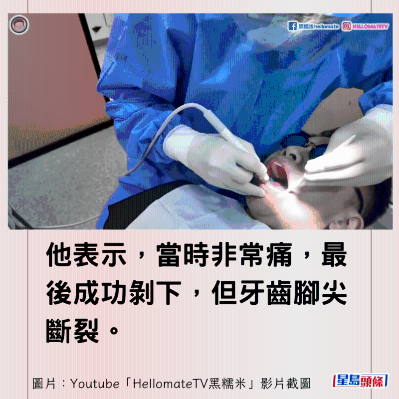 香港男子實(shí)測(cè)深圳平價(jià)洗牙種牙14