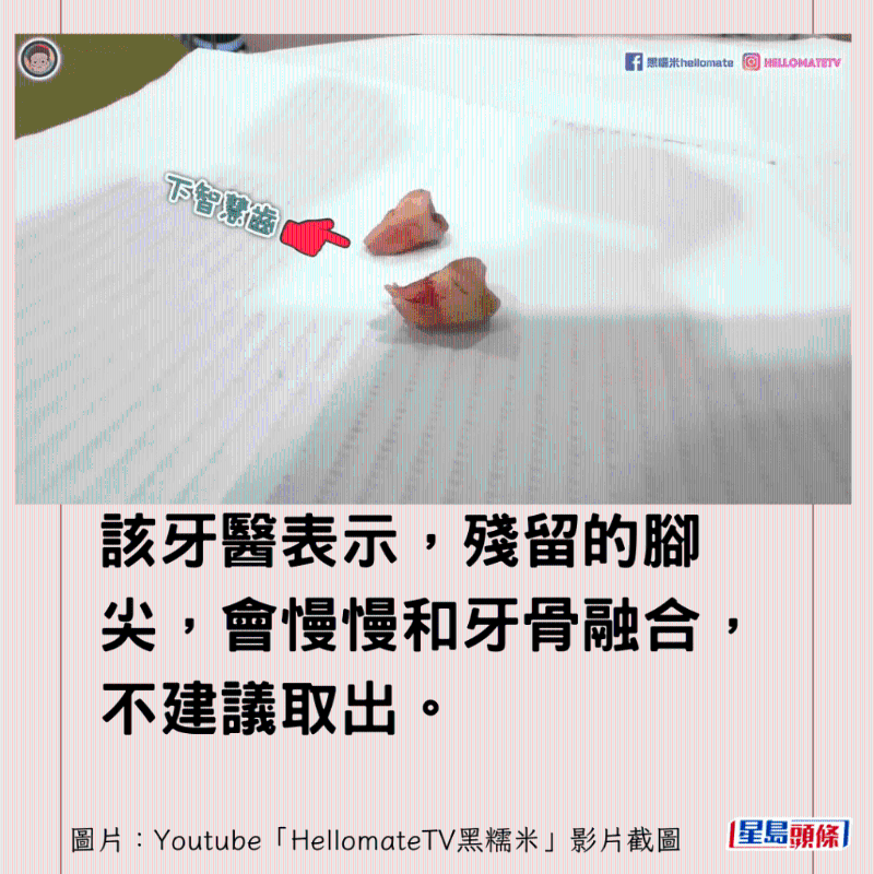 香港男子實(shí)測(cè)深圳平價(jià)洗牙種牙13