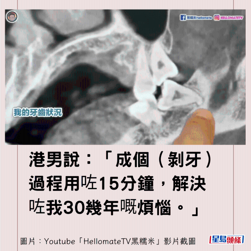 香港男子實(shí)測(cè)深圳平價(jià)洗牙種牙12