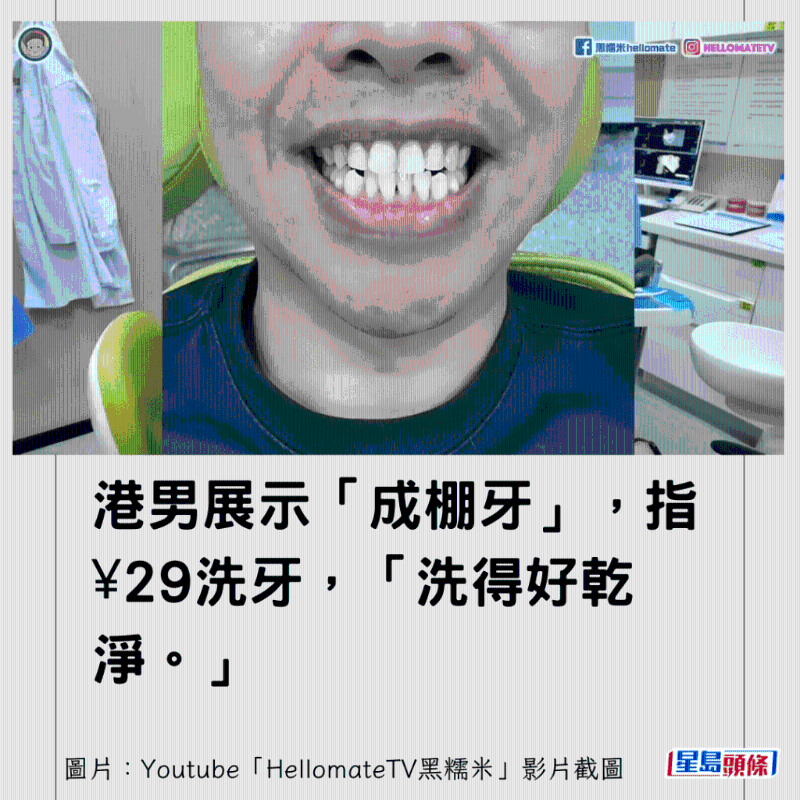 香港男子實(shí)測(cè)深圳平價(jià)洗牙種牙3