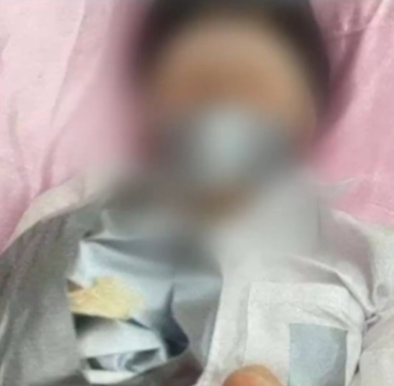 男童尾指遭割斷。